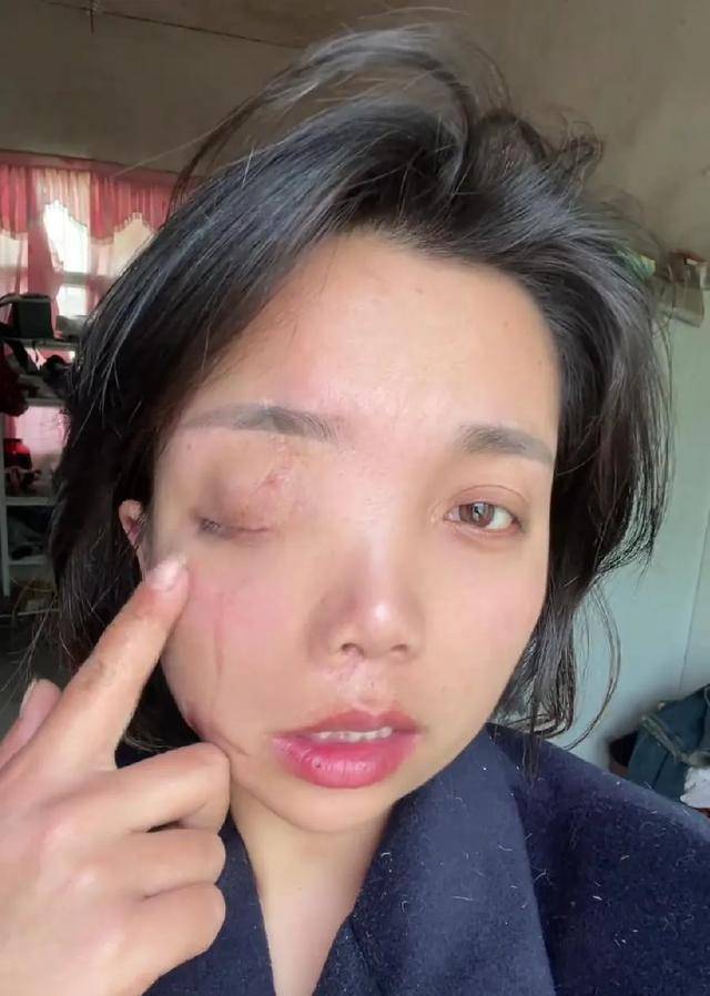 安徽女子左眼失明，办理残疾人证被拒？残联：双眼残疾可办理
